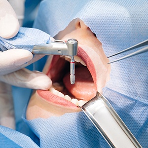 dental implant surgery is where the dental implant is permanently inserted into the jawbone