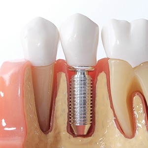 Osseointegration is where the dental implant fuses with your jawbone