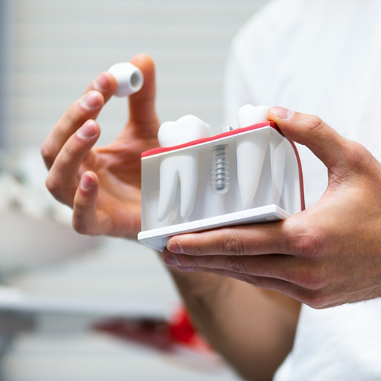 Dentist holding a model of a dental implant in between two natural teeth