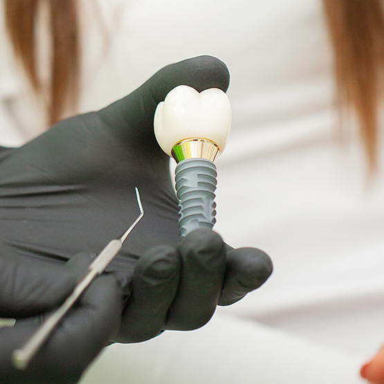 Dentist showing a dental implant to a patient