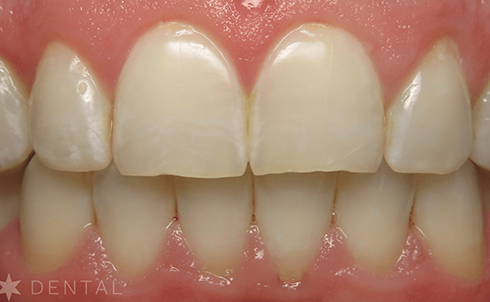 Close up of a smile with perfectly aligned teeth