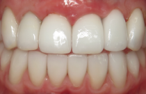 Close up of a mouth with no gaps between teeth