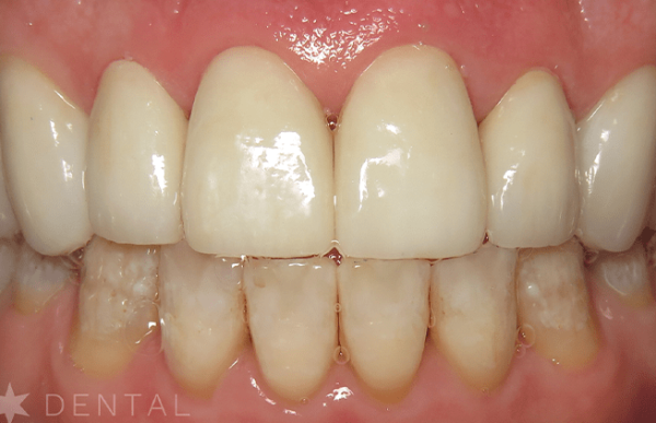 Smile Makeover: Patient B