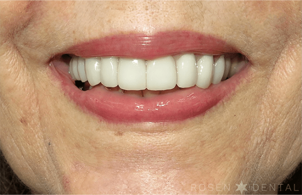 Smile Makeover: Patient F